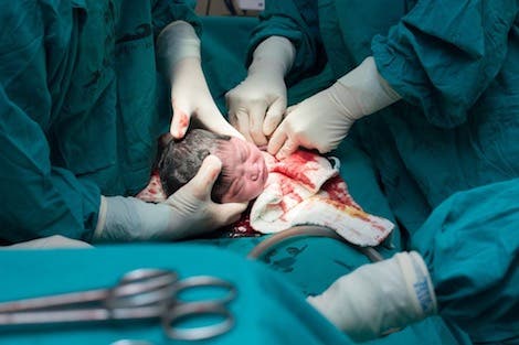 بسبب شكوك حول الولادات القيصرية … أطباء القطاع الخاص يصعدون ضد ”كنوبس“
