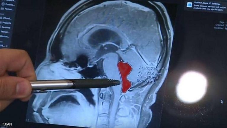 بالصور : دودة في دماغ رجل لمدة 10 سنوات .. كيف دخلت وماذا فعلت بدماغه؟