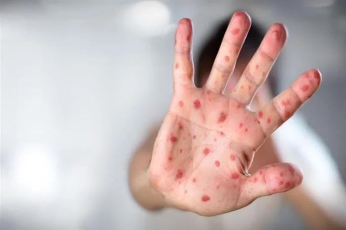 الحوز : داء " بوحمرون " يجتاح دواوير بالإقليم ووزارة الصحة توضح