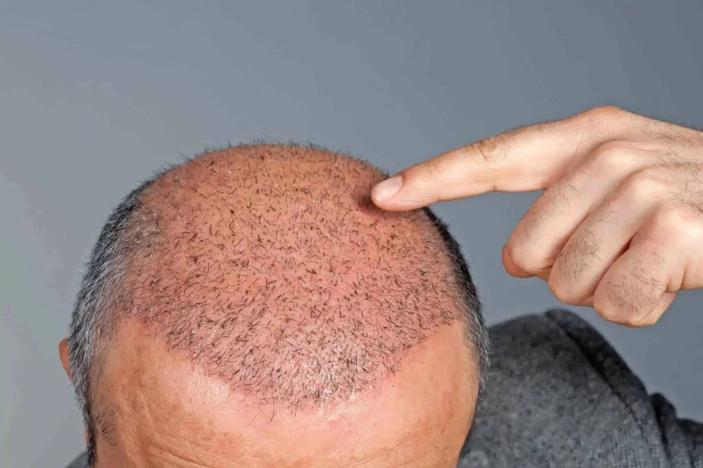عملية زراعة الشعر - صورة تعبيرية