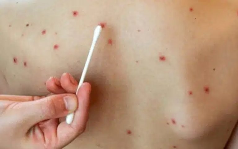 تسجيل 4 حالات إصابة بمرض "بوحمرون" داخل سجن طنجة