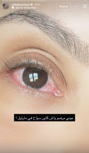 رباب أزماني تثير قلق متابعيها بسبب إصابة حادة في عينيها(صورة)