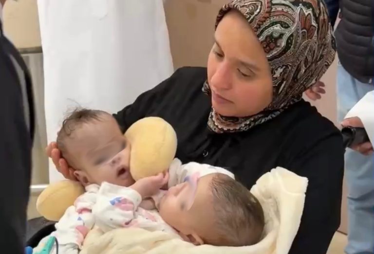 غدا.. إجراء عملية فصل التوأم المغربي «سجى وضحى» في السعودية